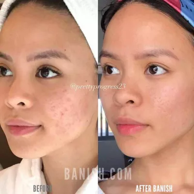 Banish, the best skincare for ordinary acne scars : Before and after Banish: ordinary acne scars disappeared